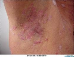 牛皮癣症状