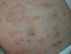 牛皮癣病因