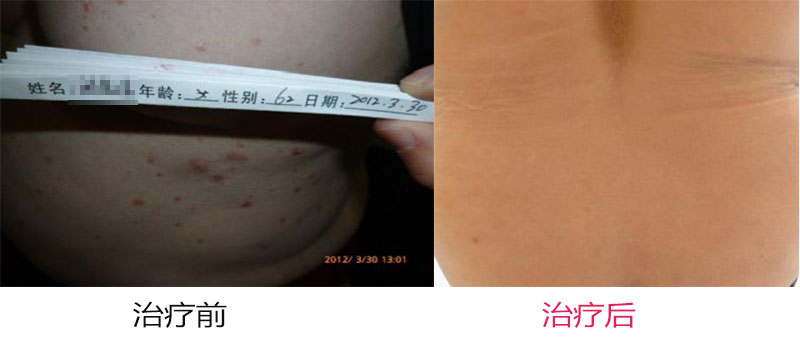 牛皮癣治疗
