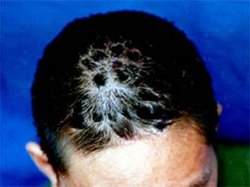 牛皮癣症状