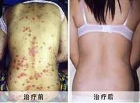 牛皮癣治疗
